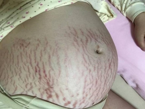 美國月子中心教您可以減淡妊娠紋的小妙招